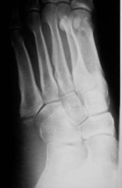 Fractured metatarsals. Avulsion fracture of the tu