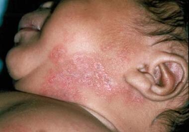 Neonatal lupus erythematosus. 