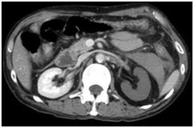 Grade V renal injury: devascularized kidney. Contr
