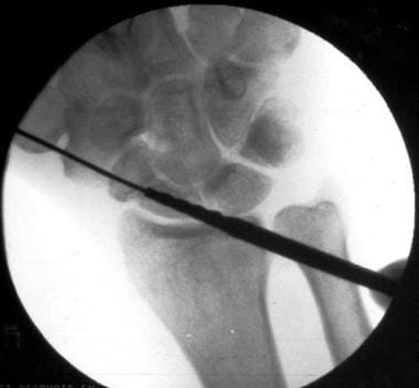 Fluoroscopic image demonstrates reaming of the sca