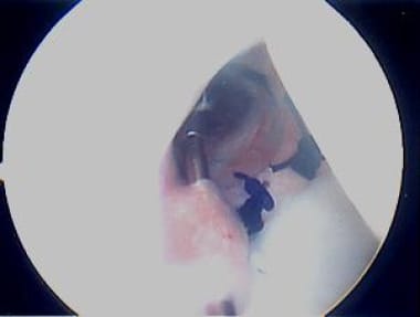 Close-up of third "pinch." Photo courtesy of Danie