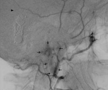 Lateral carotid arteriogram obtained 22 years afte