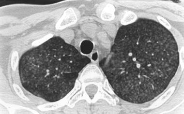 High-resolution chest CT scan of a patient with su