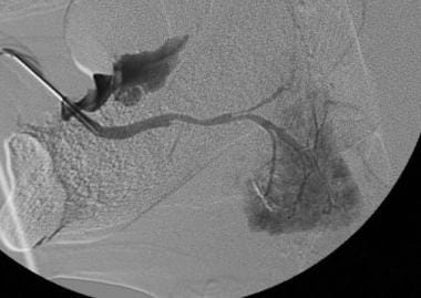 Sialogram with stenosis secondary to chronic siala