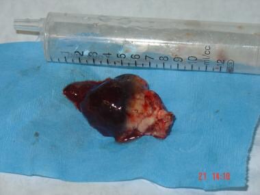 The tumor (the infratentorial mass) after excision