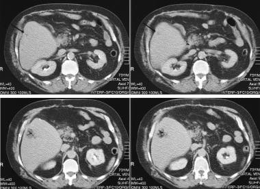 What is an abdomen MRI with or without contrast?