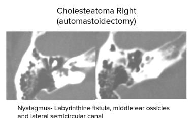 Temporal bone, acquired cholesteatoma. Axial CT sc