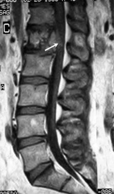 Lumbar spine trauma. Sagittal T1-weighted MRI of t