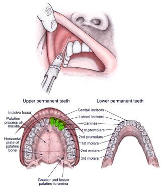 Anterior superior alveolar (ASA) nerve block. 