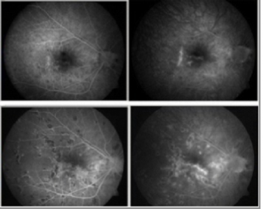 Early disease stage (top): Fluorescein angiography