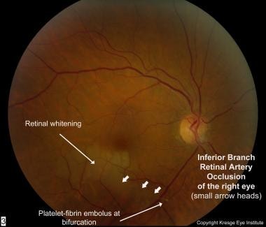Color fundus photo of right eye with inferior bran