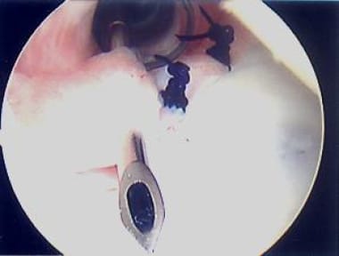Close-up of third labral pass. Photo courtesy of D