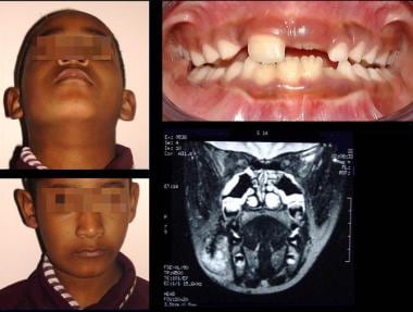 Right facial lymphatic vascular malformation with 