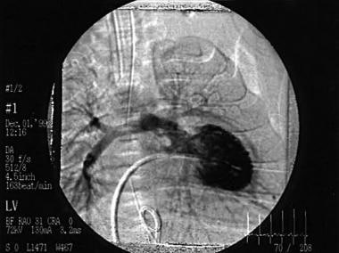 This left ventricular angiogram shows a patient wi