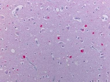 Neocortex stained alpha synuclein. The presence of
