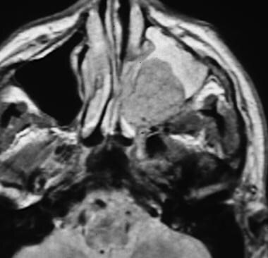 MRI of a patient with a maxillary sinus tumor in t