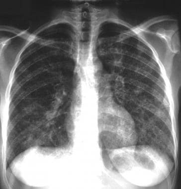 Typical radiographic appearance of lymphangitic ca