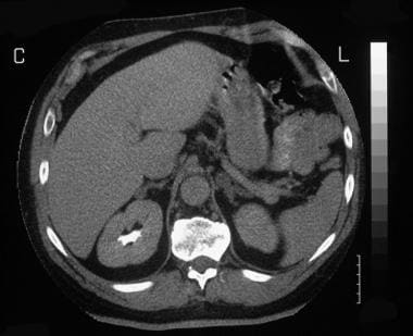 Axial enhanced CT scan in a 56-year-old man shows 