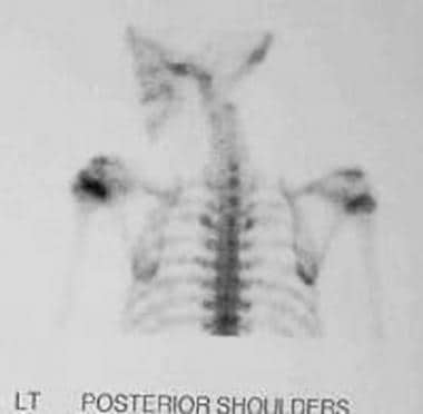 Bone scan of a proximal humeral chondroblastoma in