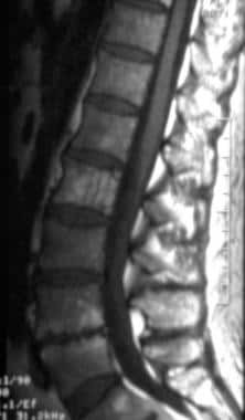 What is the typical progression of malignant spinal hemangiomas?