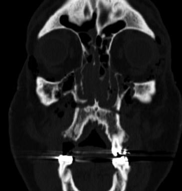 Coronal CT demonstrating a right Le Fort I fractur