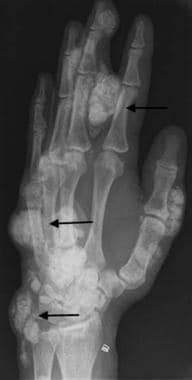 Oblique radiograph of the hand in a dialysis patie