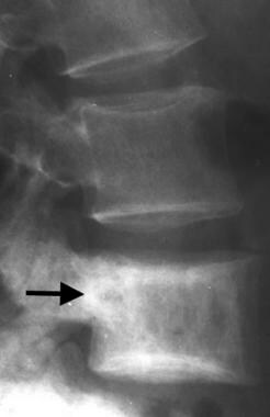 Lateral radiograph of the lumbar spine in a patien