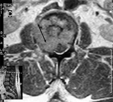 Lumbar spine trauma. Axial T1-weighted MRI of the 