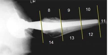 This lateral hip radiograph shows the additional n