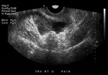Endovaginal Ultrasound Pictures 45