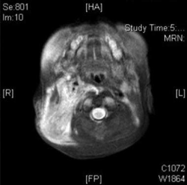 T2-weighted MRI of the infant in the image above d