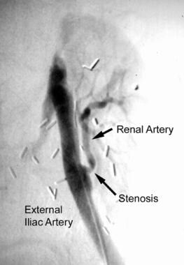 Digital subtraction angiogram showing renal artery