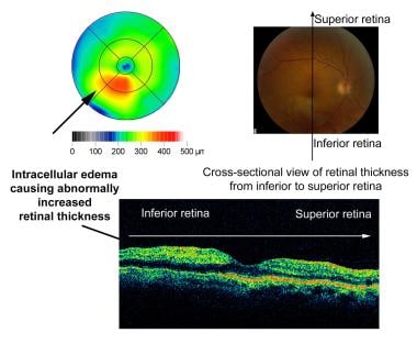 Optical coherence tomography (OCT) of right eye wi