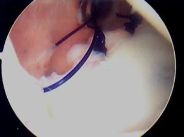 Third suture is placed. Photo courtesy of Daniel C