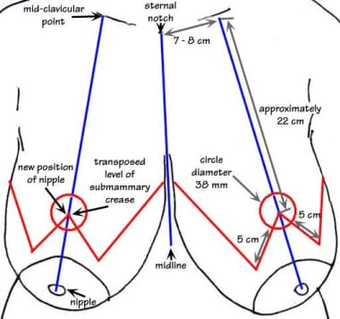 vertical-bipedicle-breast-reduction-background-history-of-the