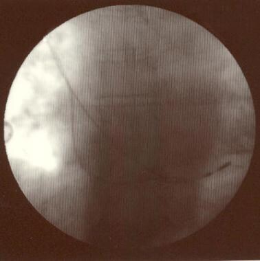 Pacemaker Malfunction. Atrial lead dislodgment. Th