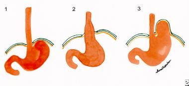 hernia hiatal esophagus normal stomach diaphragm medscape pathophysiology