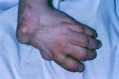 The clinical presentation of wrist arthritis can b