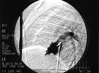 This left ventricular angiogram shows a patient wi