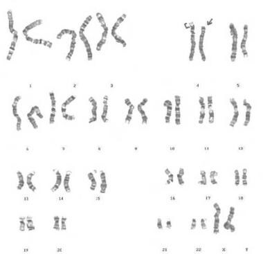 G-banded karyotype showing deletion of 4p, derived