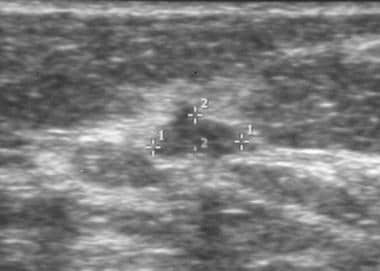 Breast cancer, ultrasonography. Radial sonogram sh
