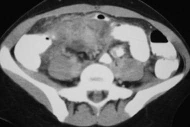 Crohn disease. Mesenteric inflammation. CT scan de