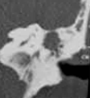 Temporal bone, acquired cholesteatoma. This image 