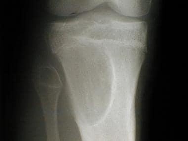 Radiograph of the proximal tibia of a 16-year-old 