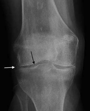 Anteroposterior radiograph of the knee in a patien