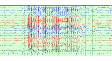 Typical absence seizure with 3-4 Hz rhythmic gener
