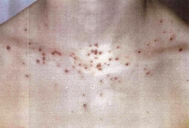 Characteristic vesicular lesions occur on sun-expo
