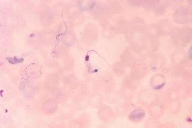 Trypanosoma cruzi in blood smear. Courtesy of Cent