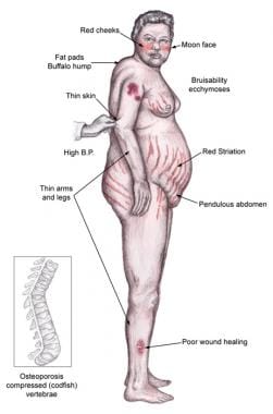 Physical findings in Cushing syndrome. 