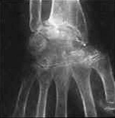 Rheumatoid arthritis of the wrist. 